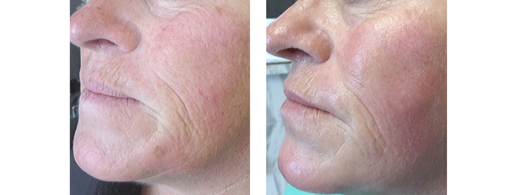 Anthelia Photo Rejuvenation Face - Wrinkles and Ageing