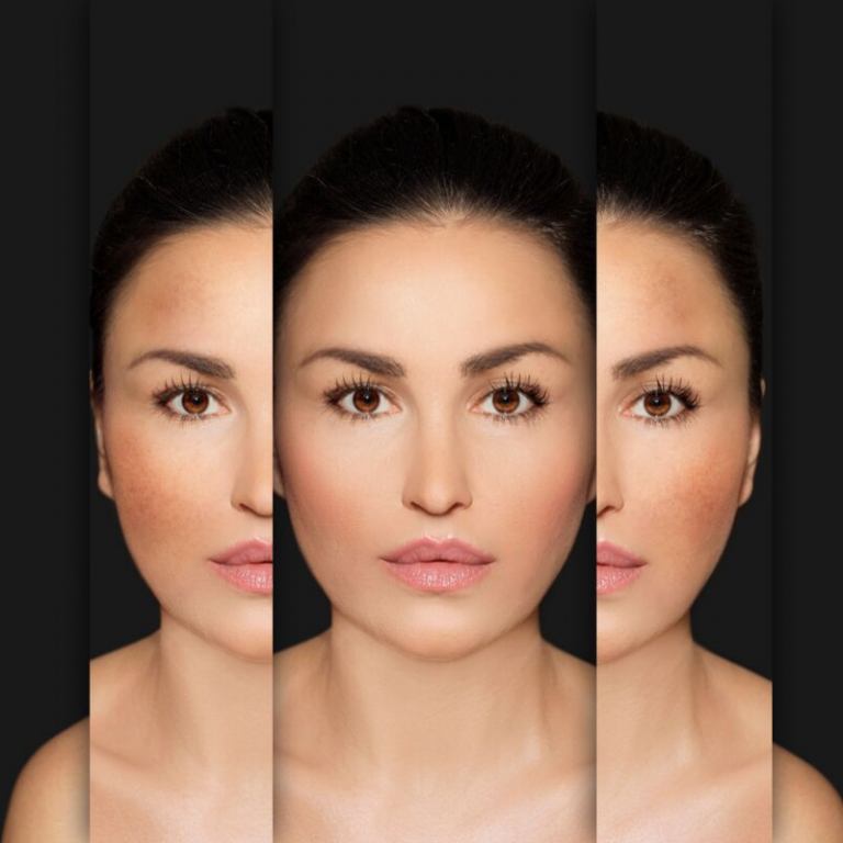 *Anthelia IPL Pigmenation