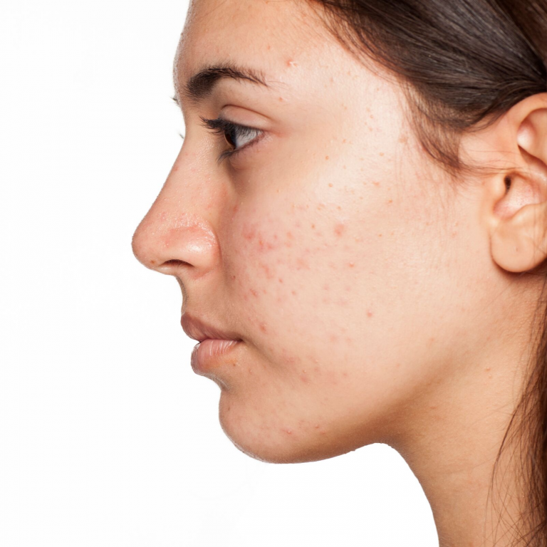 *Acne Anthelia IPL Treatment