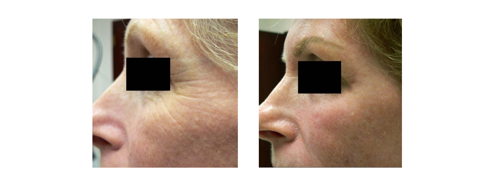 Icon MaxG - Skin Resurfacing Wrinkles