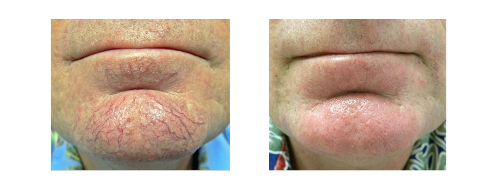 Icon MaxG - Photo Facial Chin Capillaries