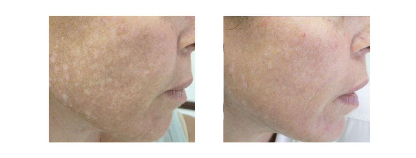 Icon MaxG - Photo Facial Uneven SKin