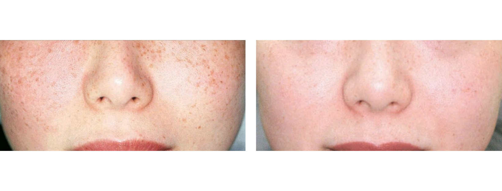 Icon MaxG - Photo Facial Freckles