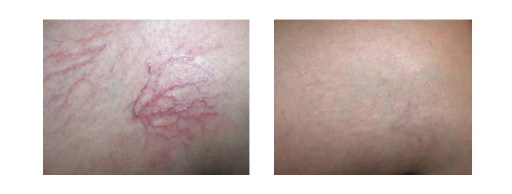 Icon MaxG - Photo Facial Vascular