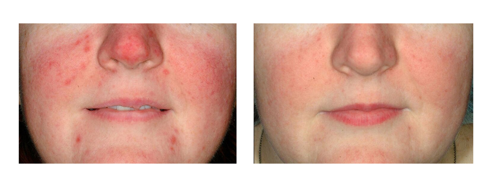 Icon MaxG - Photo Facial Redness