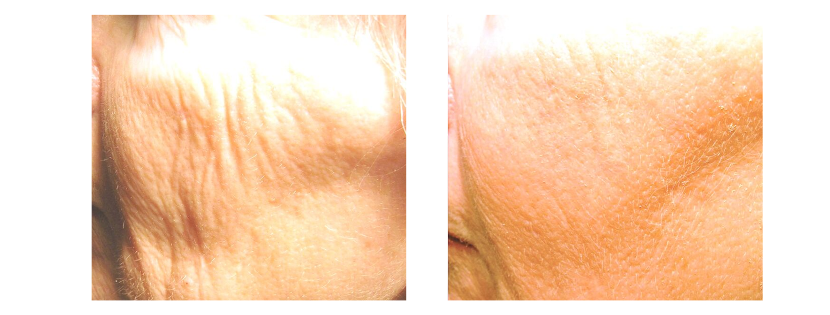 Icon MaxG - Skin Resurfacing Wrinkles