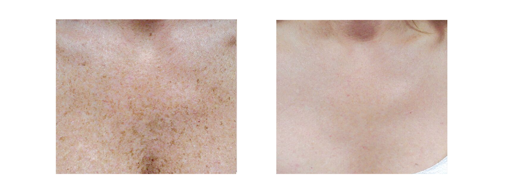 Icon MaxG - Photo Facial Sun Damage Pigmentation