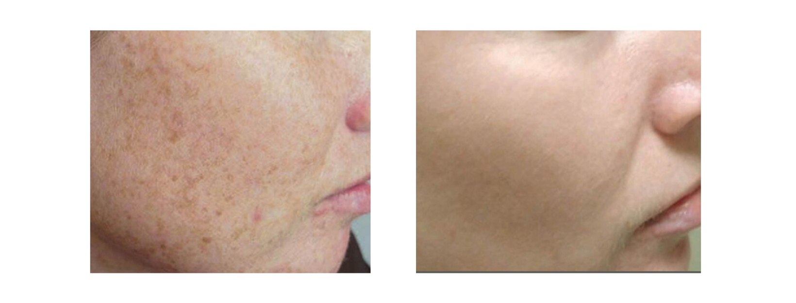 Icon MaxG - Photo Facial Uneven Skin