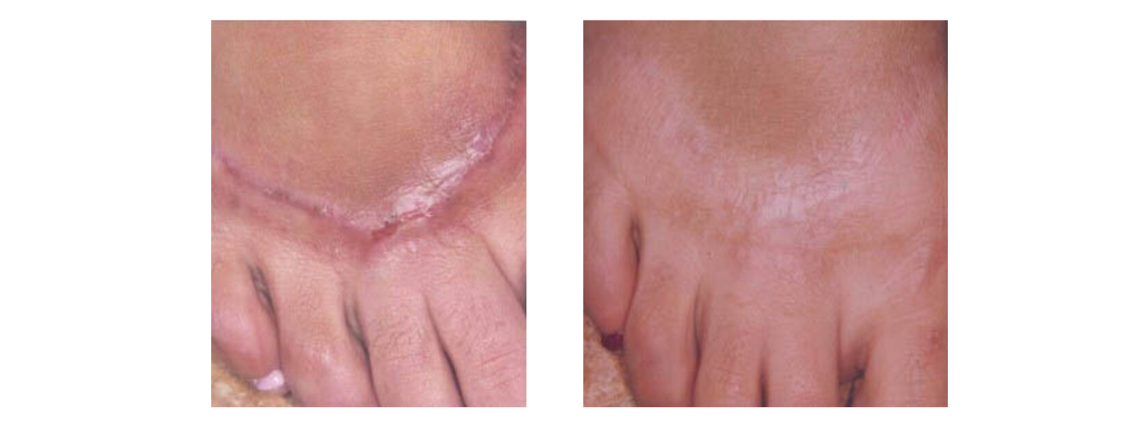 Icon MaxG - Skin Resurfacing Foot Scar