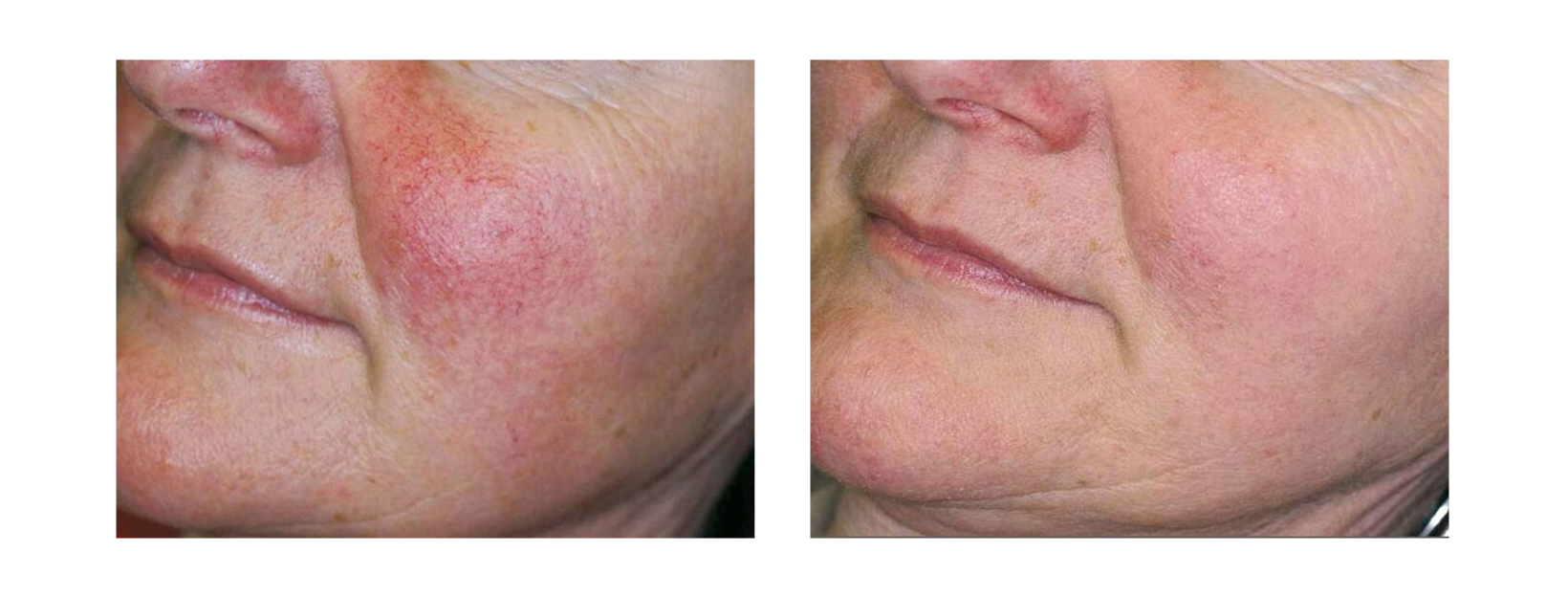 Icon MaxG - Photo Facial Rosacea
