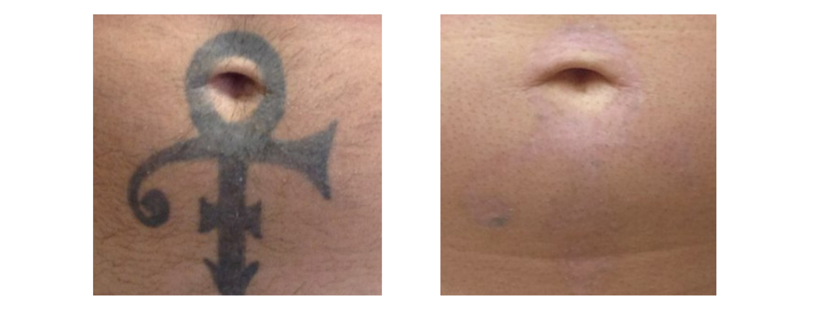 Tattoo Removal Belly Button Black Tone
