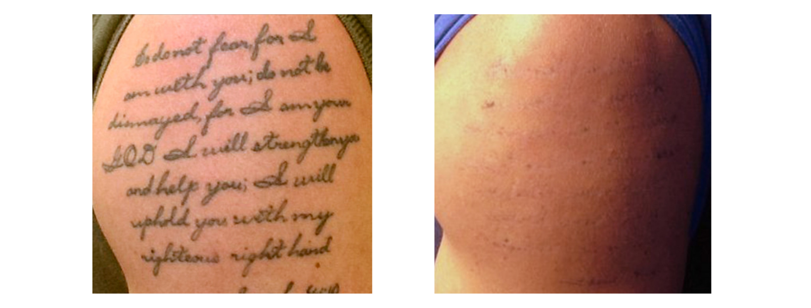 Tattoo Removal Arm Quote Black Tone