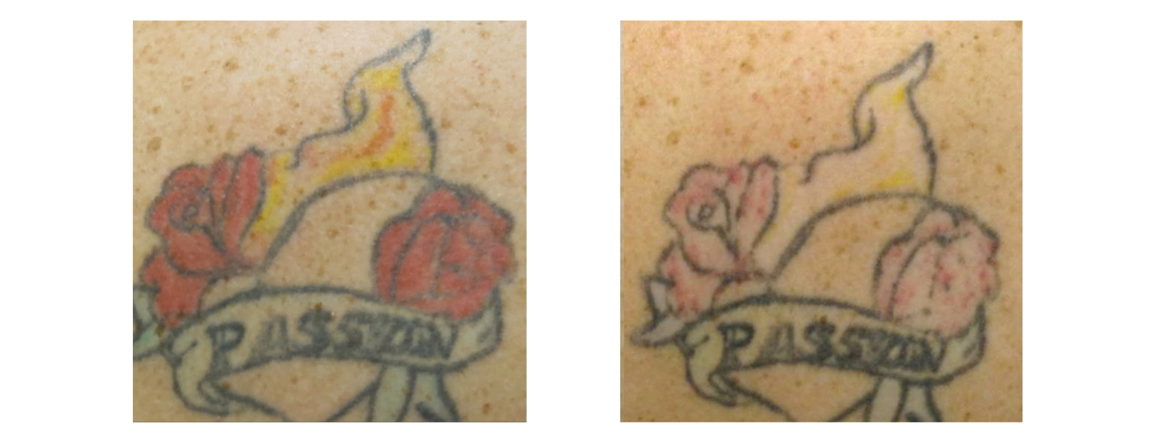 Tattoo Removal Colours Red and Yellow