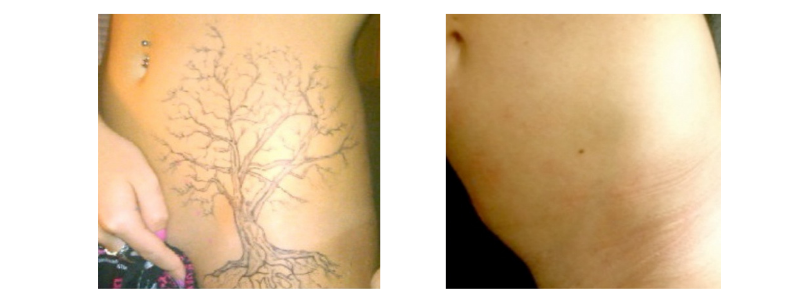 Tattoo Removal Stomach and Hip Dark Tones