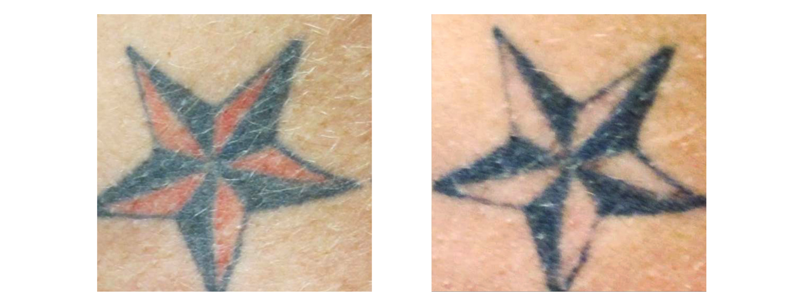 Tattoo Removal Red Tone from inner section