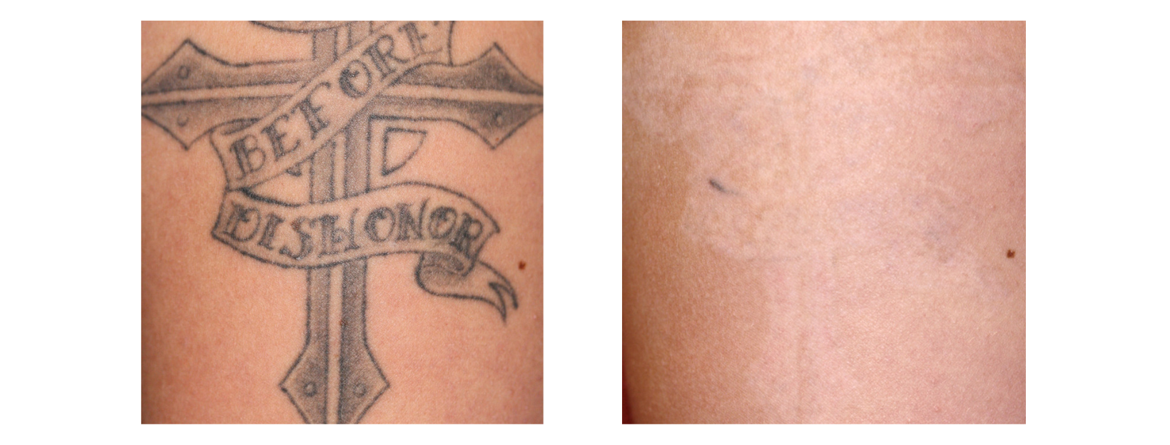 Tattoo Removal Dark Tones and writing