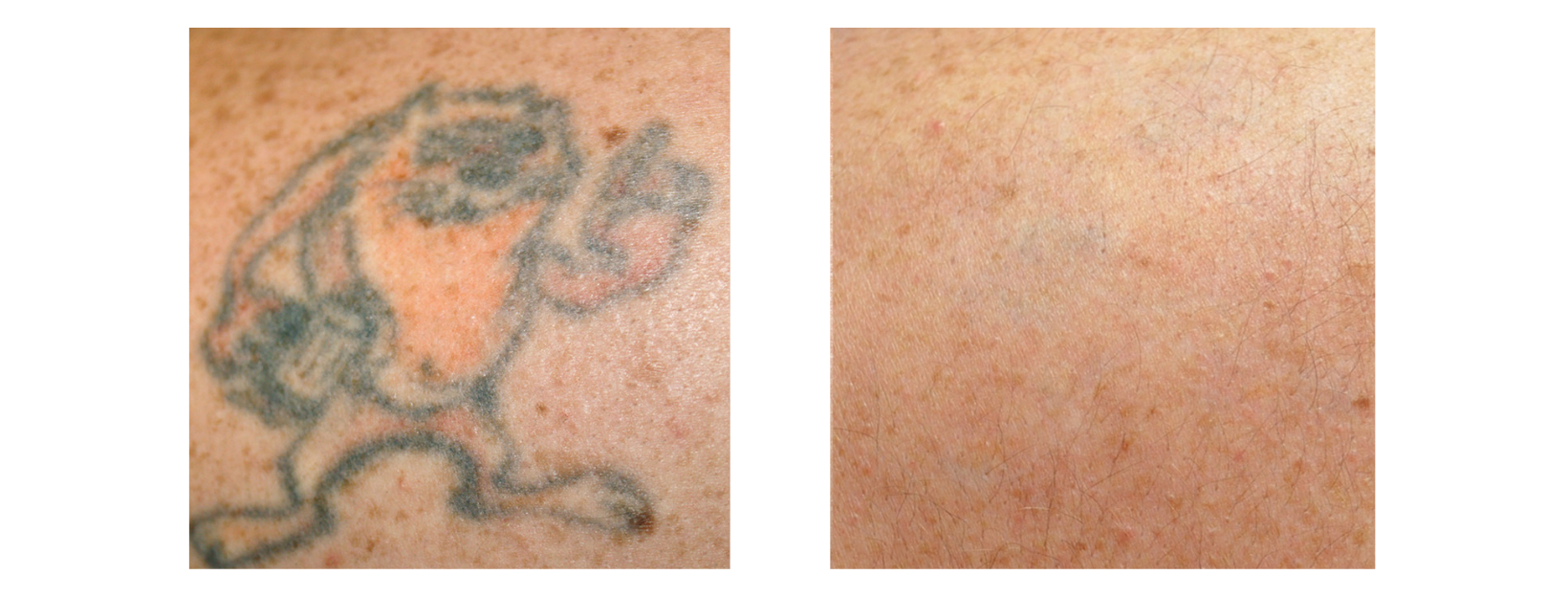 Tattoo Removal Black and Red Tones