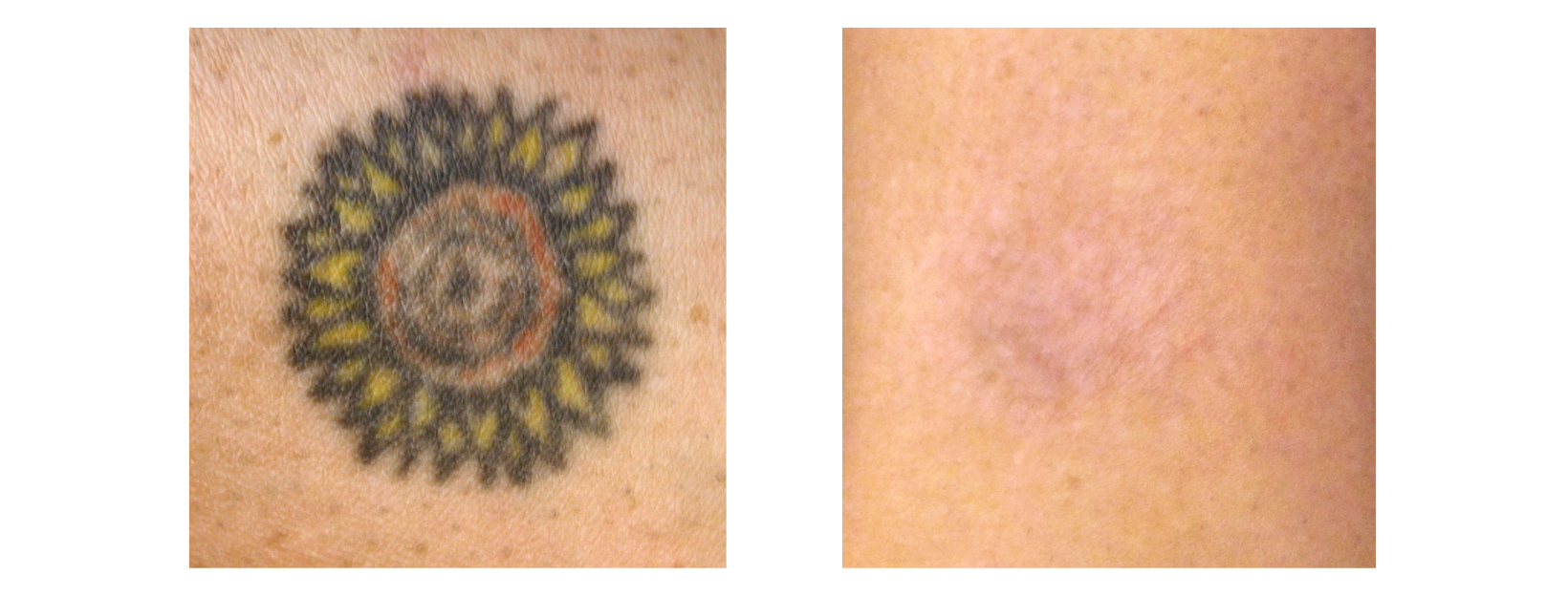Tattoo Removal Black, Yellow and Red Tones