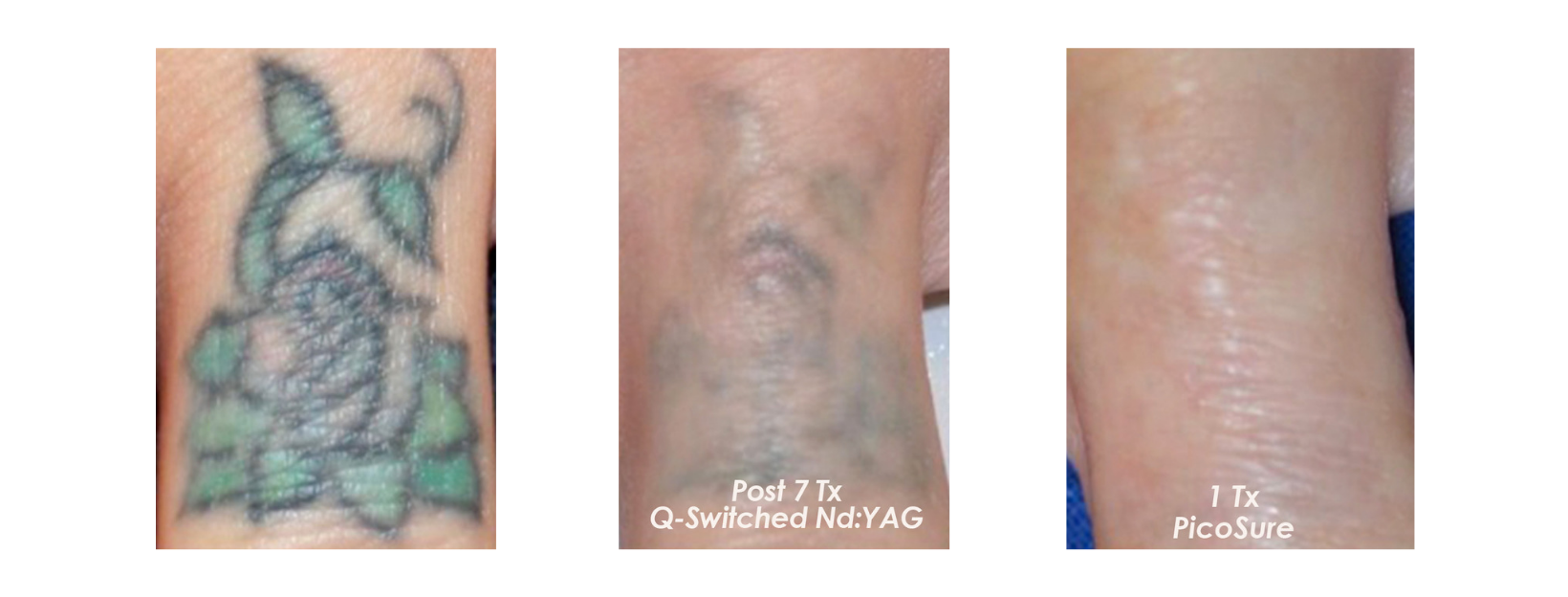 Tattoo Removal Coloured Green/Blue