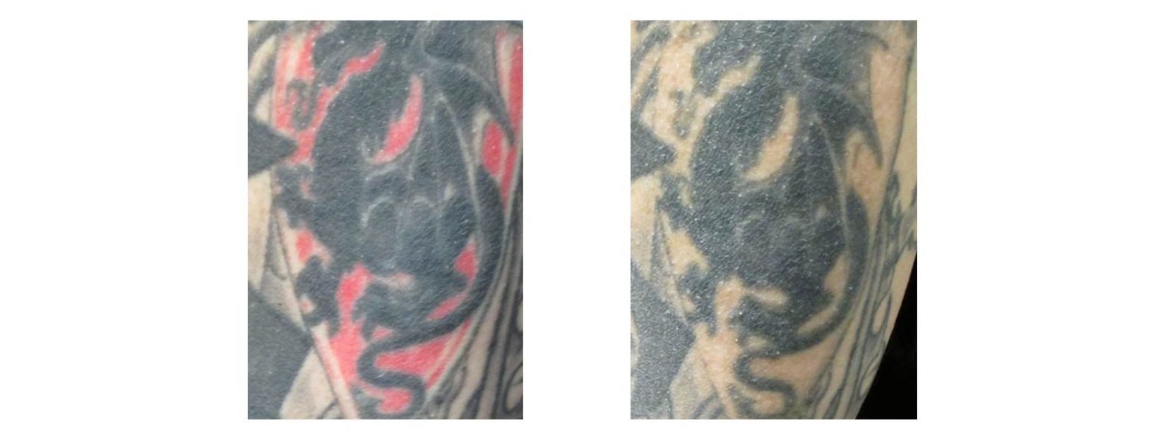 Tattoo Removal Colour Red