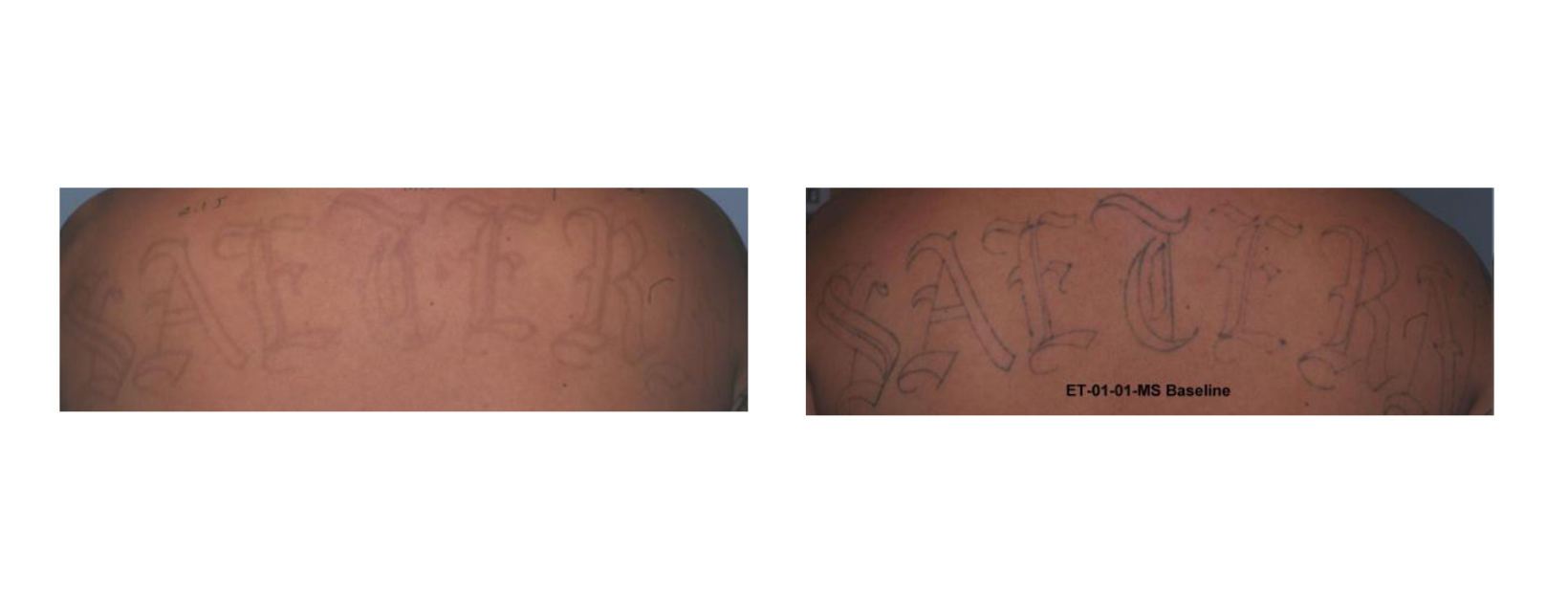 Tattoo Removal Back