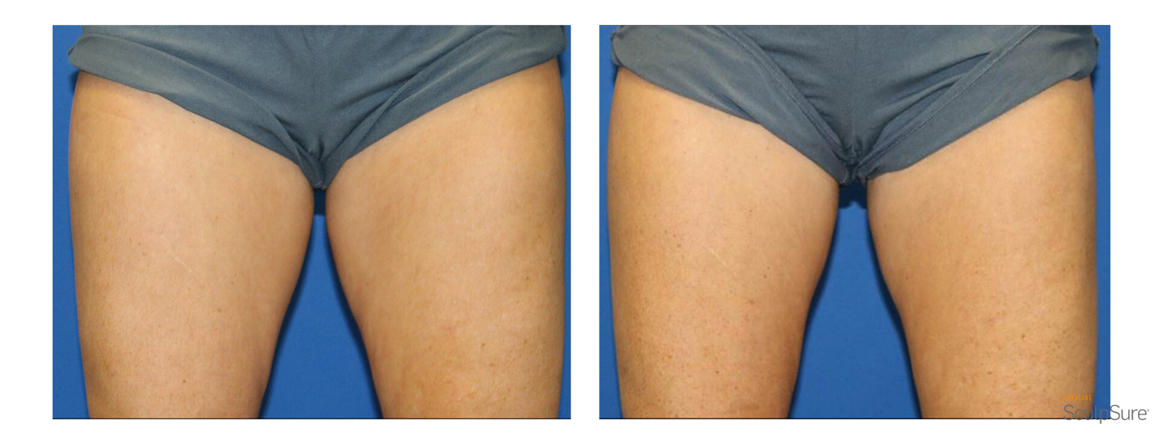SculpSure Inner Thighs
