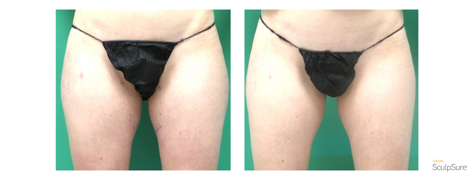 SculpSure Inner Thighs