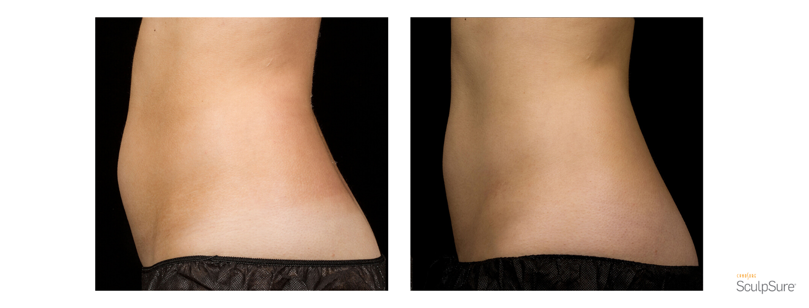 SculpSure Stomach