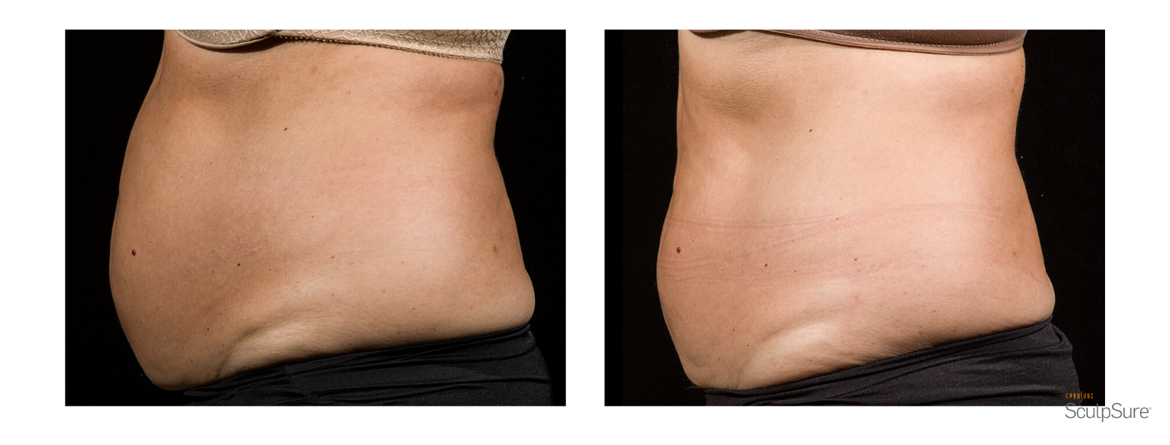 SculpSure Stomach