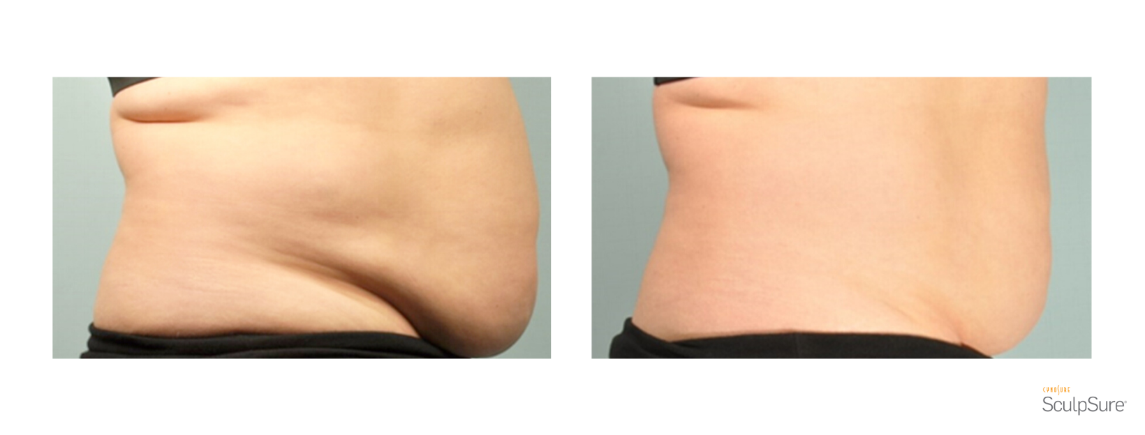 SculpSure Stomach