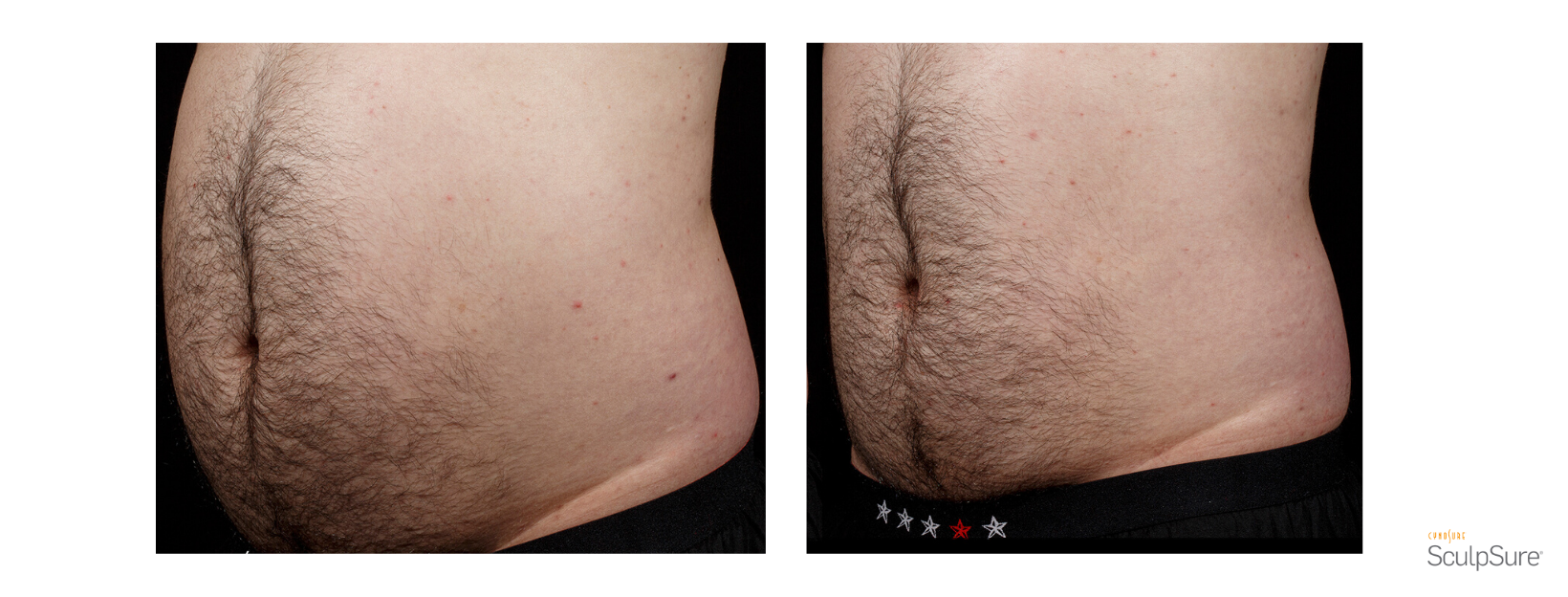 SculpSure Male Stomach