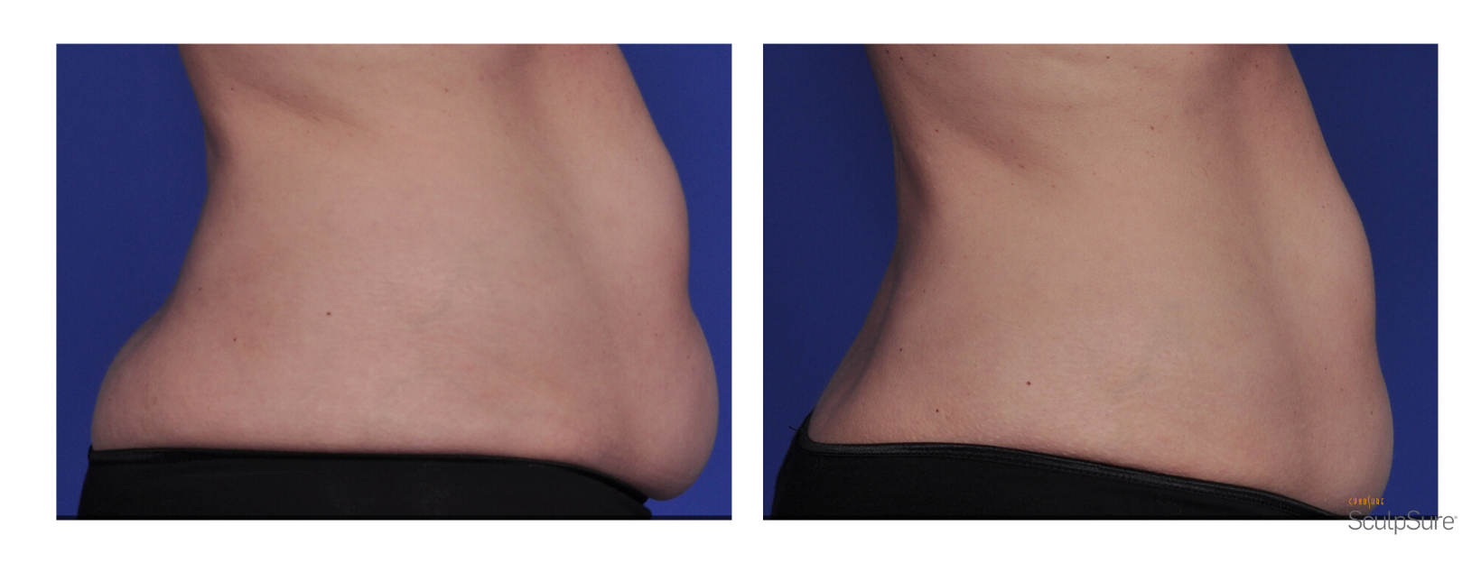 SculpSure Back and Stomach