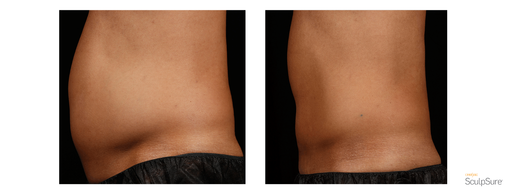 SculpSure Stomach and Love handles