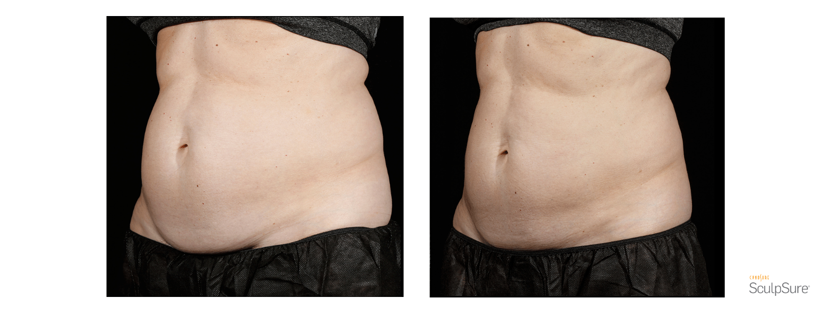 SculpSure Stomach
