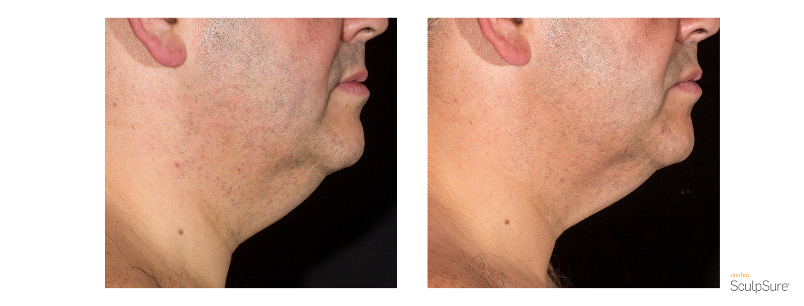 SculpSure Male Chin