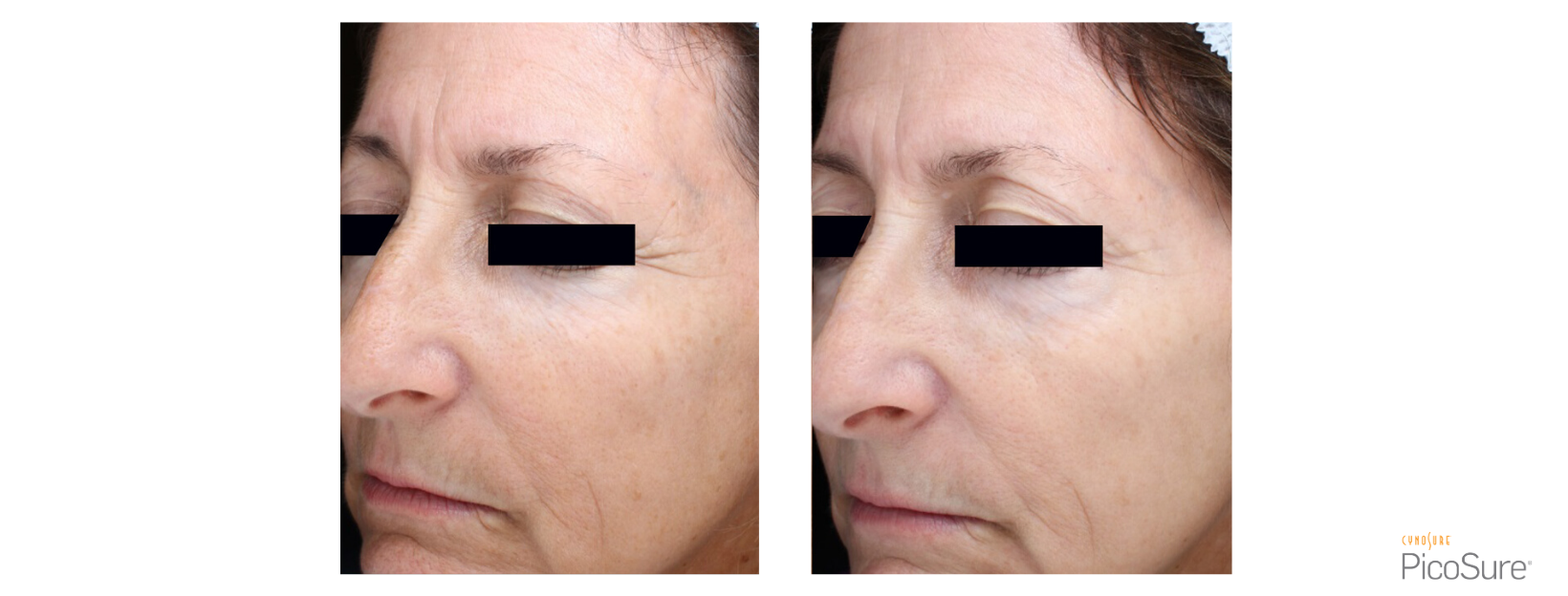 PicoSure Fine Lines & Wrinkles EyePicoSure Fine Lines & Wrinkles Left Side Face