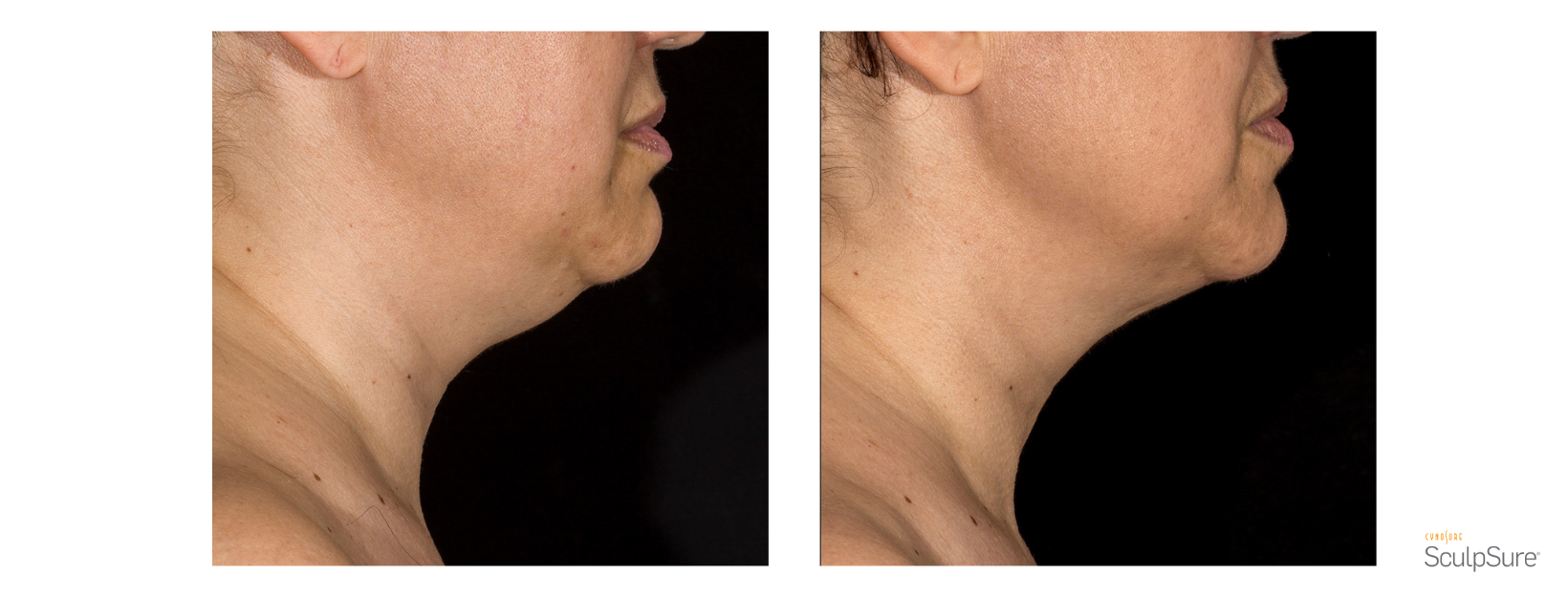 SculpSure Chin
