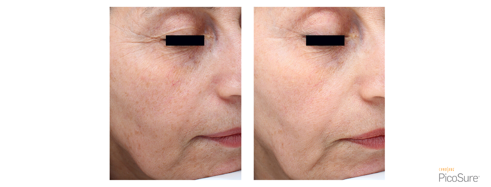 PicoSure Fine Lines & Wrinkles Right side face