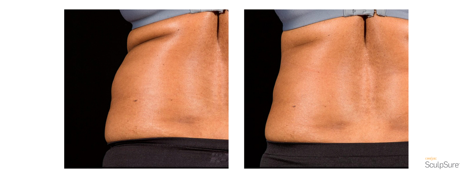 SculpSure Back and Love Handles