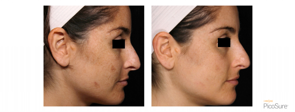 PicoSure Hyperpigmentation Right side of face