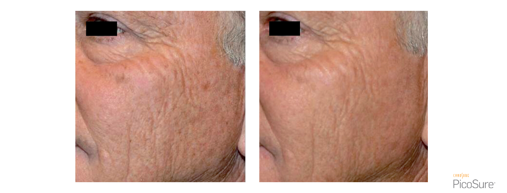 PicoSure Fine Lines & Wrinkles Man Face
