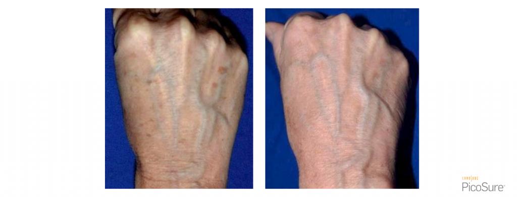 PicoSure Hyperpigmentation Hands