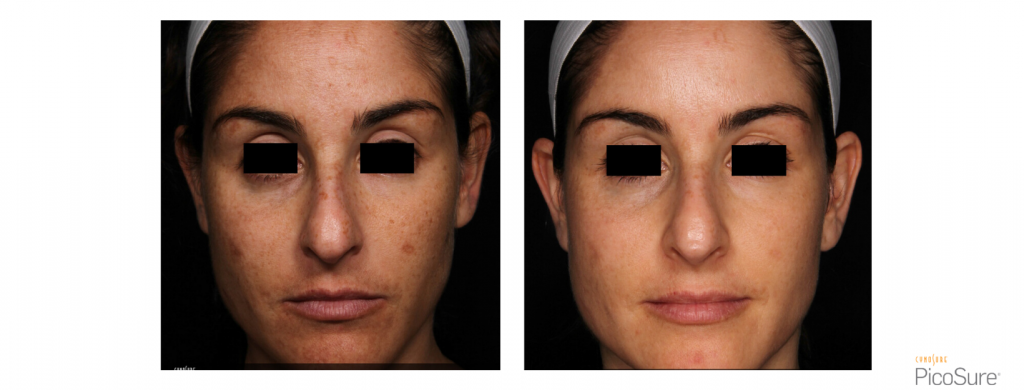 PicoSure Hyperpigmentation front of face