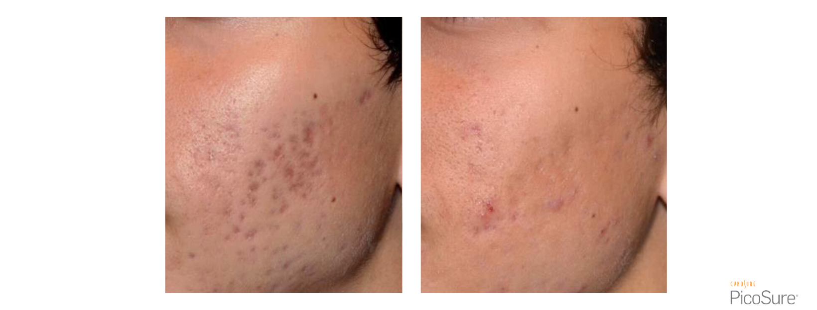 PicoSure Acne Scarring Cheek