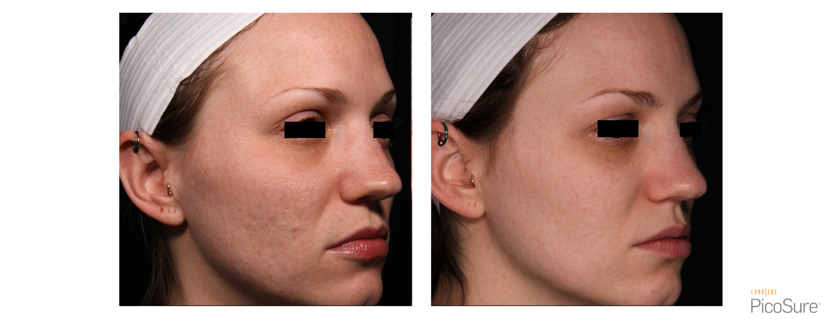 PicoSure Acne Scarring Right side face