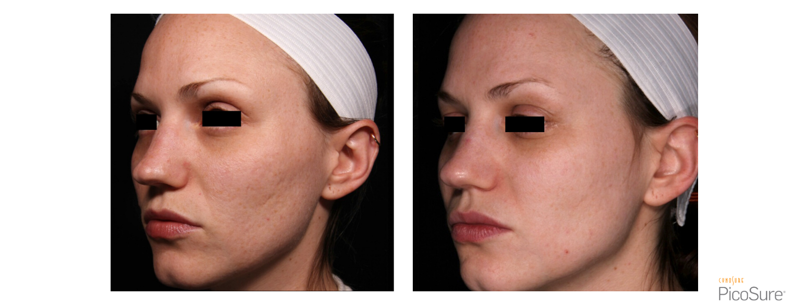 PicoSure Acne Scarring Left side face