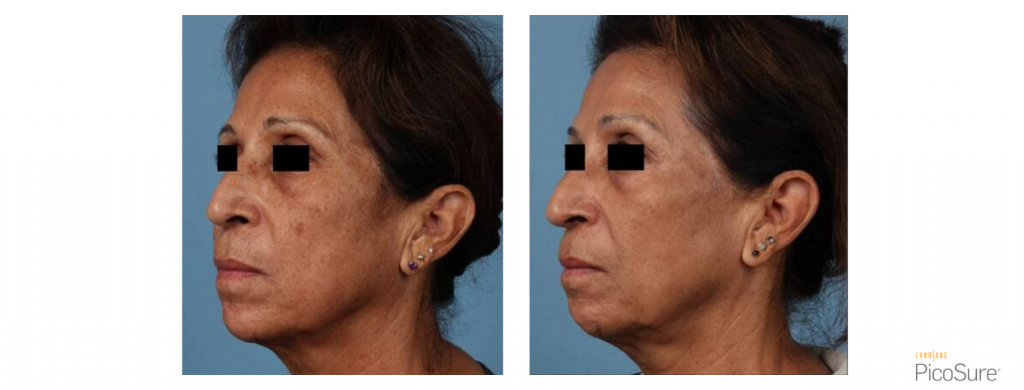 PicoSure Hyperpigmentation side of face 3