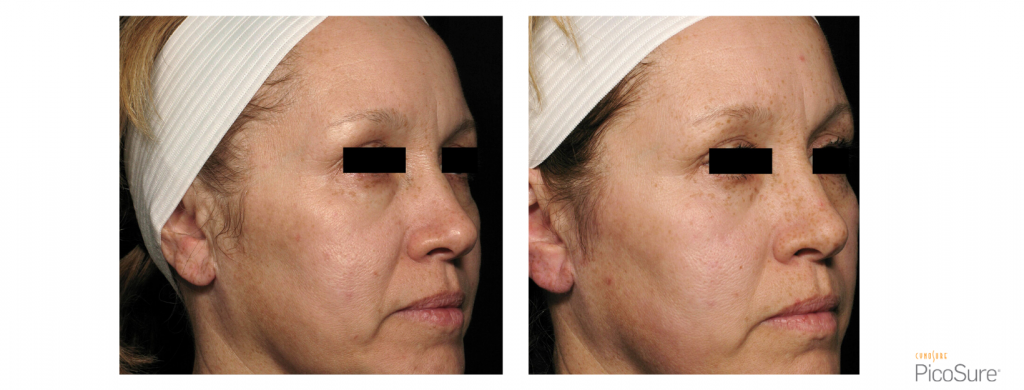 PicoSure Hyperpigmentation side of face 2