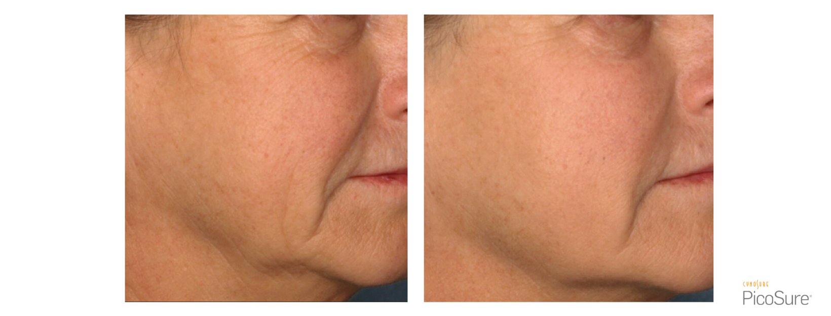 PicoSure Fine Lines & Wrinkles Cheeks and mouth