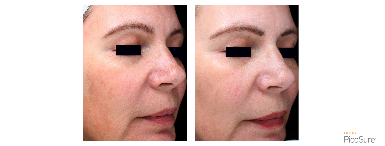 PicoSure Fine Lines & Wrinkles Side of Face